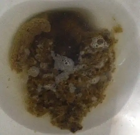 真心恳求消化科医生帮忙,差不多快一年了,拉的大便,形状怪异.