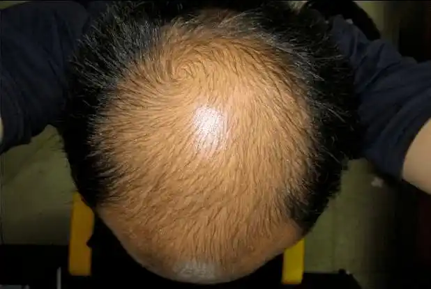 脂溢性脱发又被称为雄激素脱发,是最常见的一种脱发类型,在很多脱发