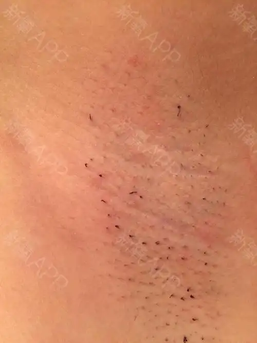 脱腋毛项目术后第0天