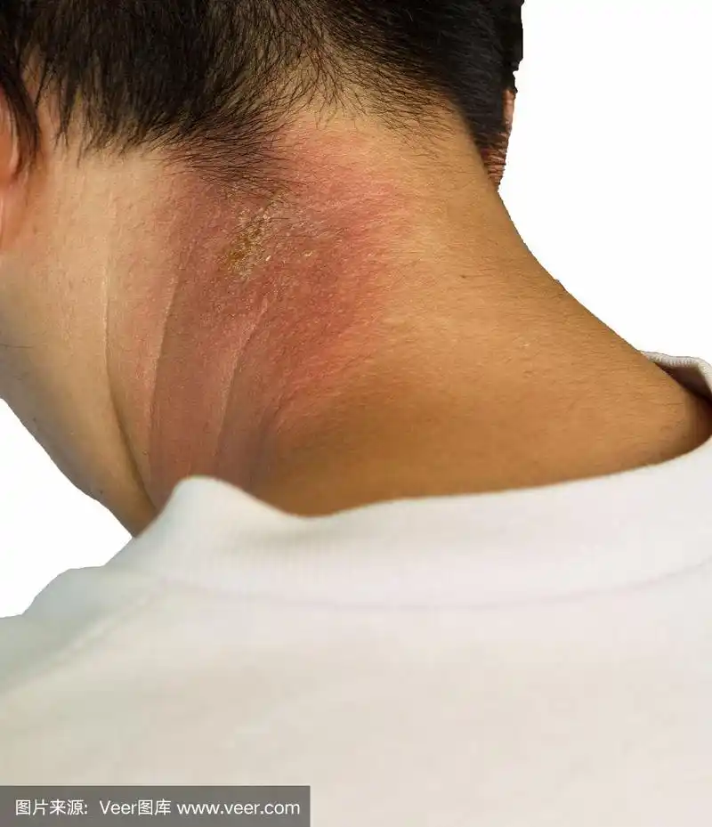 颈部皮疹在白色背景下孤立