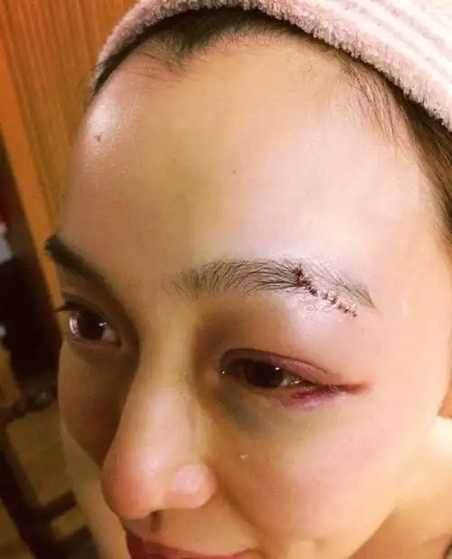 范玮琪深夜上厕所摔倒 满脸血缝20针