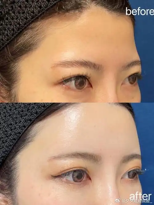 自体脂肪填充额头,效果对比!