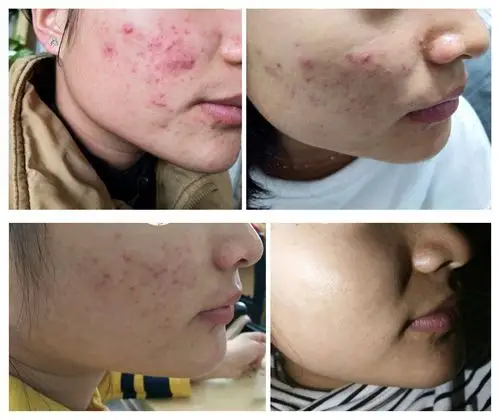 长痘7年,原来99%的人在祛痘上都做错了,感谢沐凡老师