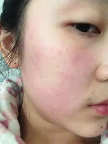 脸部过敏快速消除偏方教你轻松甩掉敏感肌 - 333文库