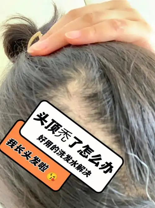 拯救秃头脱发