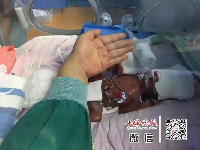 妈妈怀孕6个月产下巴掌大女婴!医生拍下14张照片,张张让人落泪