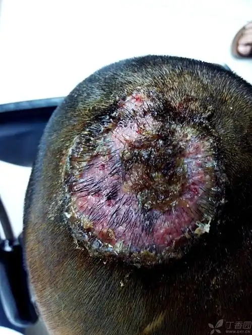 【病例讨论】这个头皮是肿么回事?请教园内大侠指点 [病例帖]