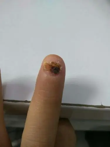 上个月把指甲撞掉了,去医院缝了两针,现在张成这个这样正常吗?
