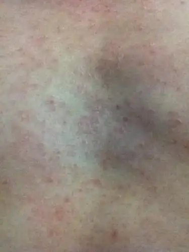 我的胸口前起皮发痒怎么回事?