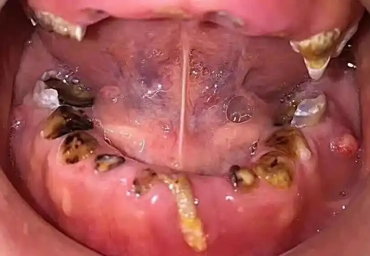 20180228百会口腔为什么乳牙蛀牙也要补这张图就是最好的答案