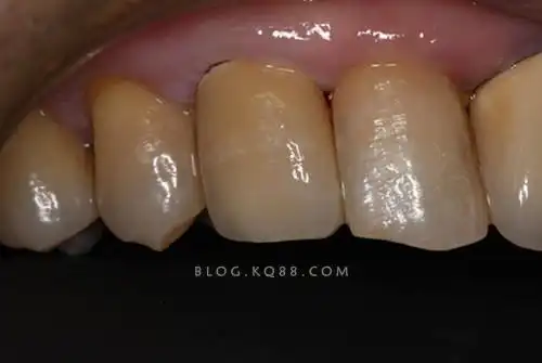 征文:新的征程之单颗牙修复--刘勇