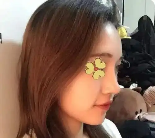 垫鼻基底果图来袭让你拥有高挺的鼻子