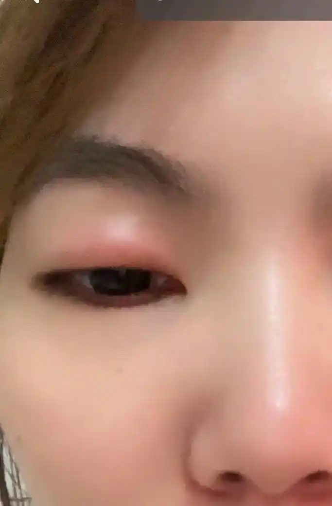 眼睛肿的睁不开.身上被叮了好几个包,整个人 - 抖音