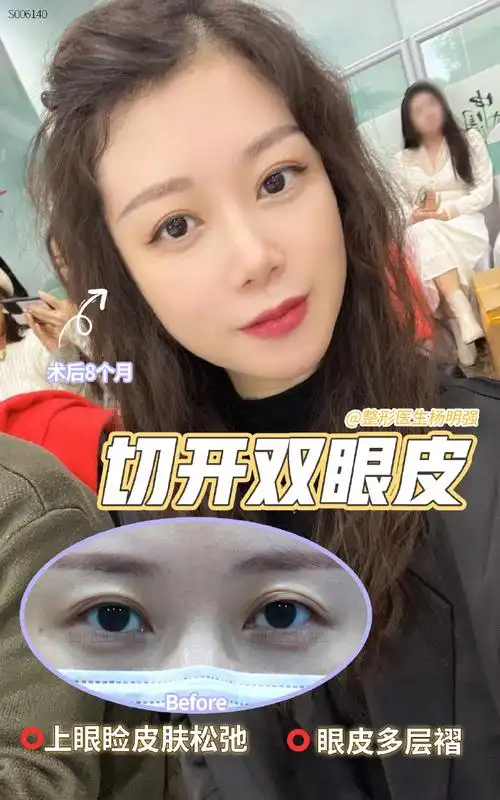 眼整形杨明强##双眼皮