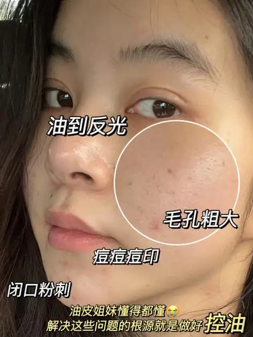 这瓶原液简直鲨我啊啊啊本人常年油皮 毛孔粗大之前用过不少被夸的