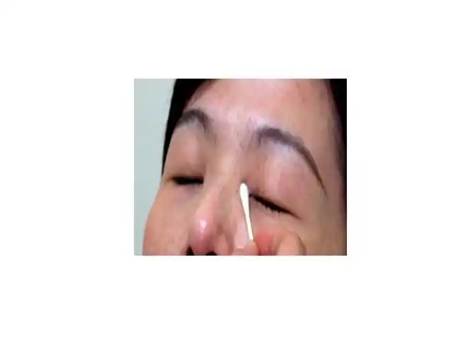 (八)如为药膏时,则病人眼睛往上看,将眼药膏一公分点入眼睑窝,病人