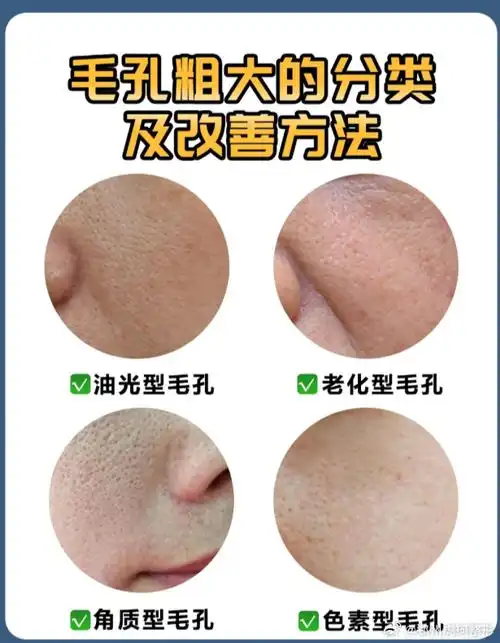 每种对应的治疗方案也不同:    97油光型:油脂分泌旺盛,堵塞毛孔