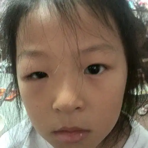 小孩眼睛肿了2天了有用过眼药水没有好转