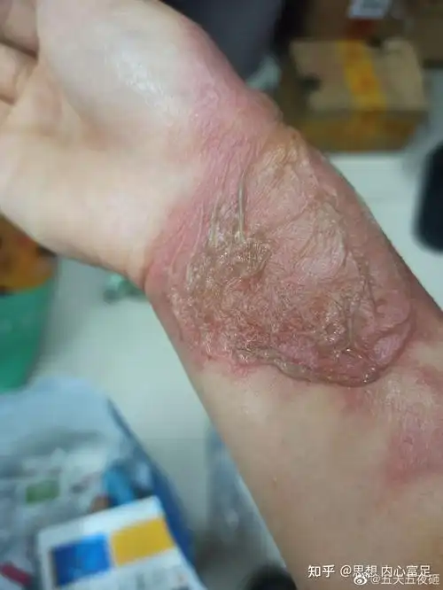 手被开水烫伤了怎么办