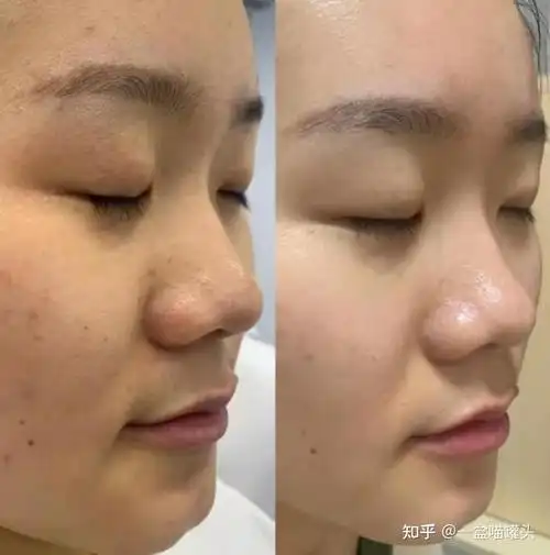 免疫力差也容易感冒,还经常熬夜,然后致使脸色比较暗沉,气色差