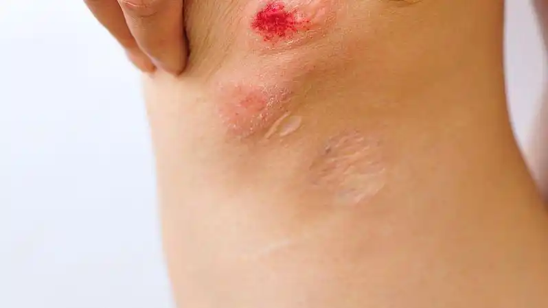 安庆怀宁县神经性皮炎_安庆怀宁县神经性皮炎的症状