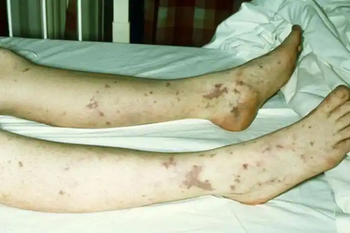 白血病腿上红斑图