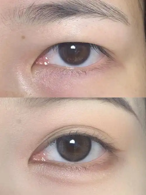 内双肿泡眼伪素颜消肿附双眼皮教程