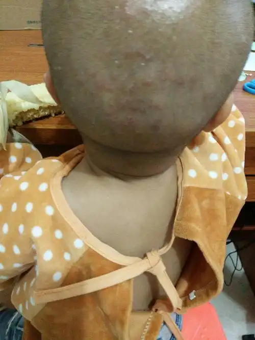 2016-06-18 18:20    浏览  33333  推荐回答 考虑是上火引起的毛囊炎