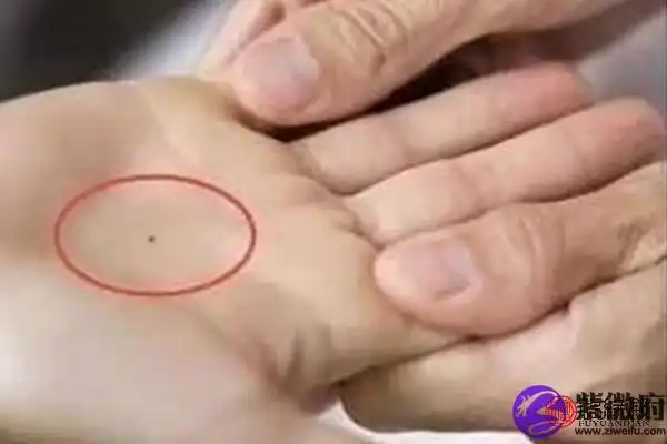 女性右手手心突然长痣