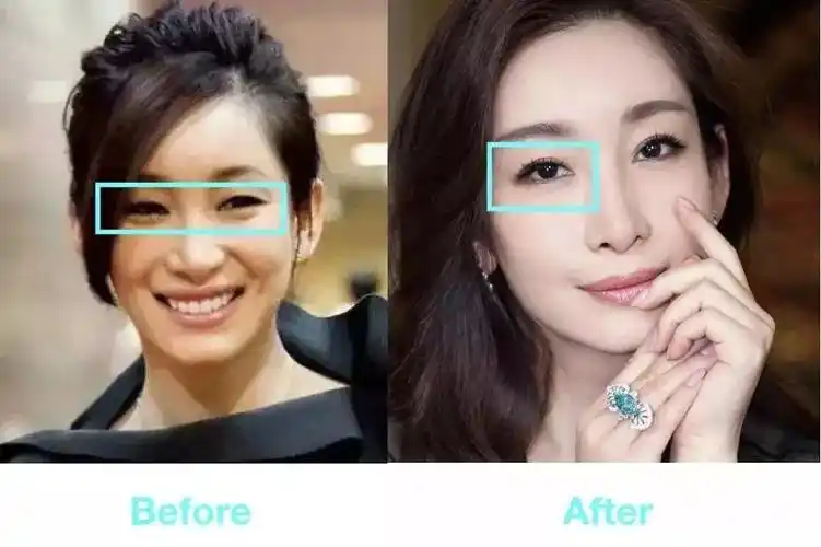 秦海璐的双眼皮割得还是很成功的,虽然单眼皮的时候很有个人特色,但是