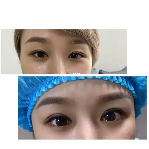 精切修复埋线双眼皮完成单侧对比