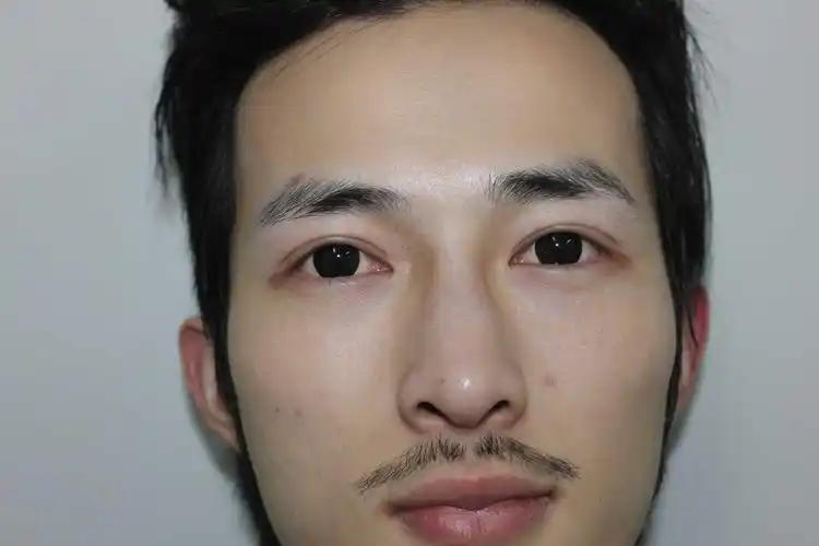 男生做双眼皮手术是什么体验?