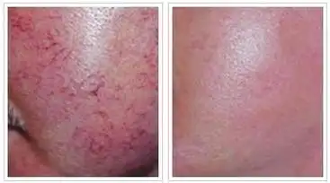 红血丝的成因及解决方案