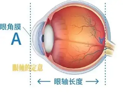 近视与眼轴. #只有照片能记录这份珍贵 #没有撤退可言继续坚 - 抖音