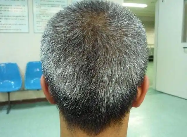 为什么白头发越长越多?你以为是老了,医生:或与这4个原因有关