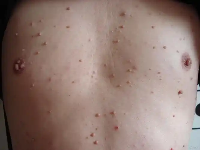 今天见一例皮肤病 拿捏不准 一起参详!