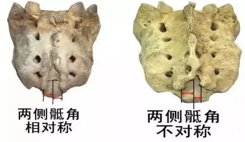 两侧骶角对称性