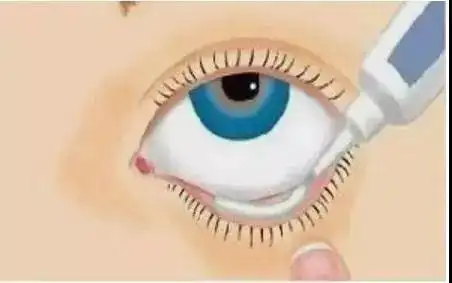 ②食指轻拉下眼睑,暴露结膜囊,把约1厘米长的眼膏涂入结膜囊内,轻闭