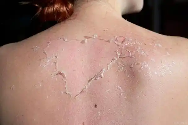 后背出油多是什么原因,怎么办