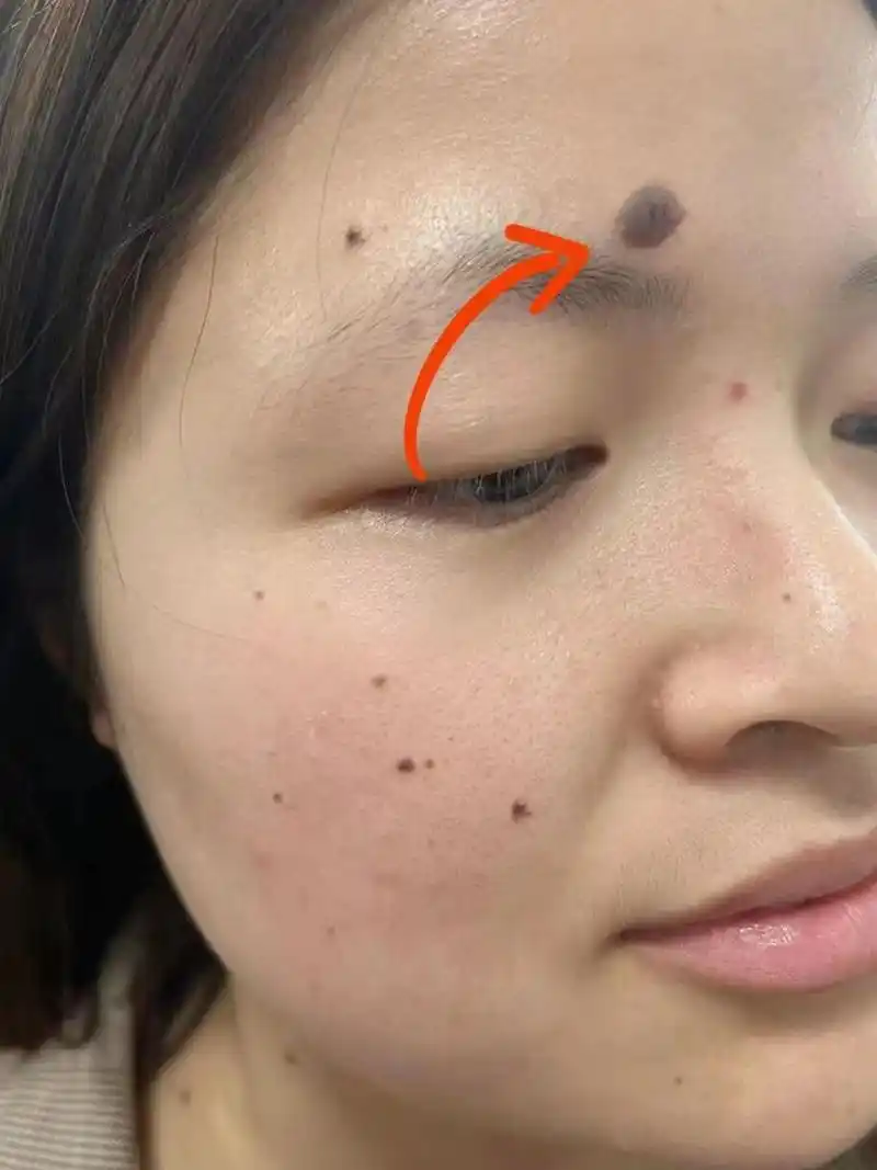 记录:因为脸上痣太多去三甲挂科被骂(社死) 现在想起来还是感觉有点