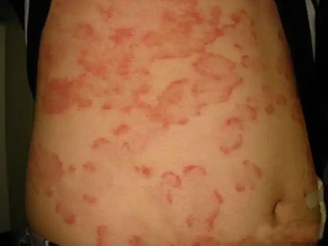 体癣症状新兴专家指出:体癣是一种真菌性皮肤病,具有很强的传染性.