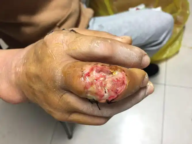 男66岁,右手中指近侧指间关节结节破溃
