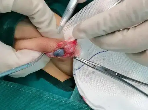 我院外科紧急联动多个科室救治睾丸扭转男孩与卵巢扭转女孩