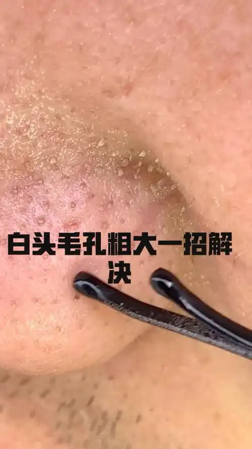 皮肤出油,毛孔粗大一招解决