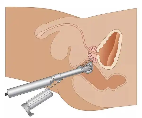 聪明漂亮!睾丸穿刺手术全过程痛吗"骨肉之情"-第2张图片-陌上花网