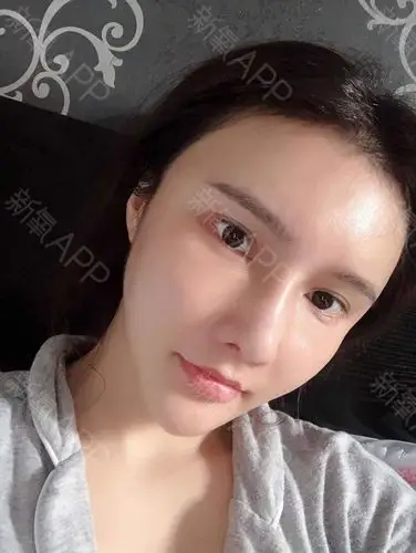 深圳自体脂肪全脸填充好不好_效果图_林369自体脂肪全脸填充术后第5天