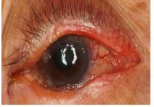 腺癌 睑缘及睑结膜面黄白色隆起皮脂腺癌发病率在我国眼睑恶性肿瘤
