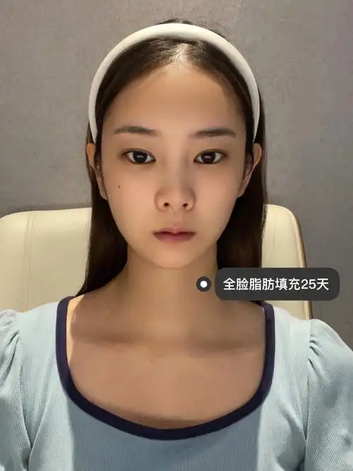 27岁老阿姨全脸脂肪填充第25天