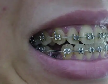 2012/11/02 下排第一小臼齿拔牙