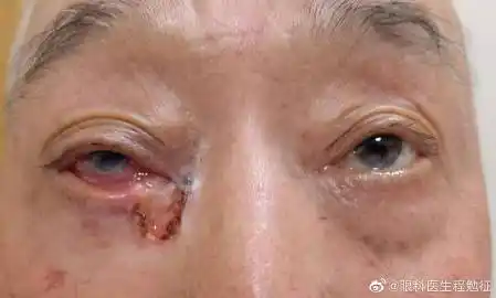 科普一下,基底细胞癌是眼睑最常见的恶性肿瘤,常发生于内眦部,有色素